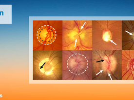 Multi-label deep learning for comprehensive optic nerve head segmentation through data of fundus images