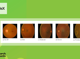 Diabetic retinopathy detection using Bilayered Neural Network classification model with resubstitution validation